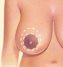 Breast Reduction 01