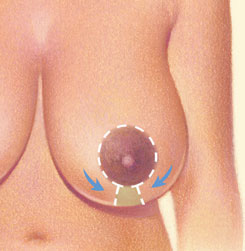 Breast Reduction 02