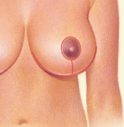 Breast Reduction 03