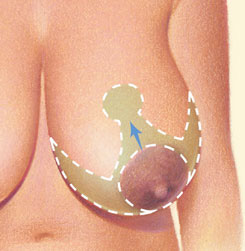 Breast Reduction 04