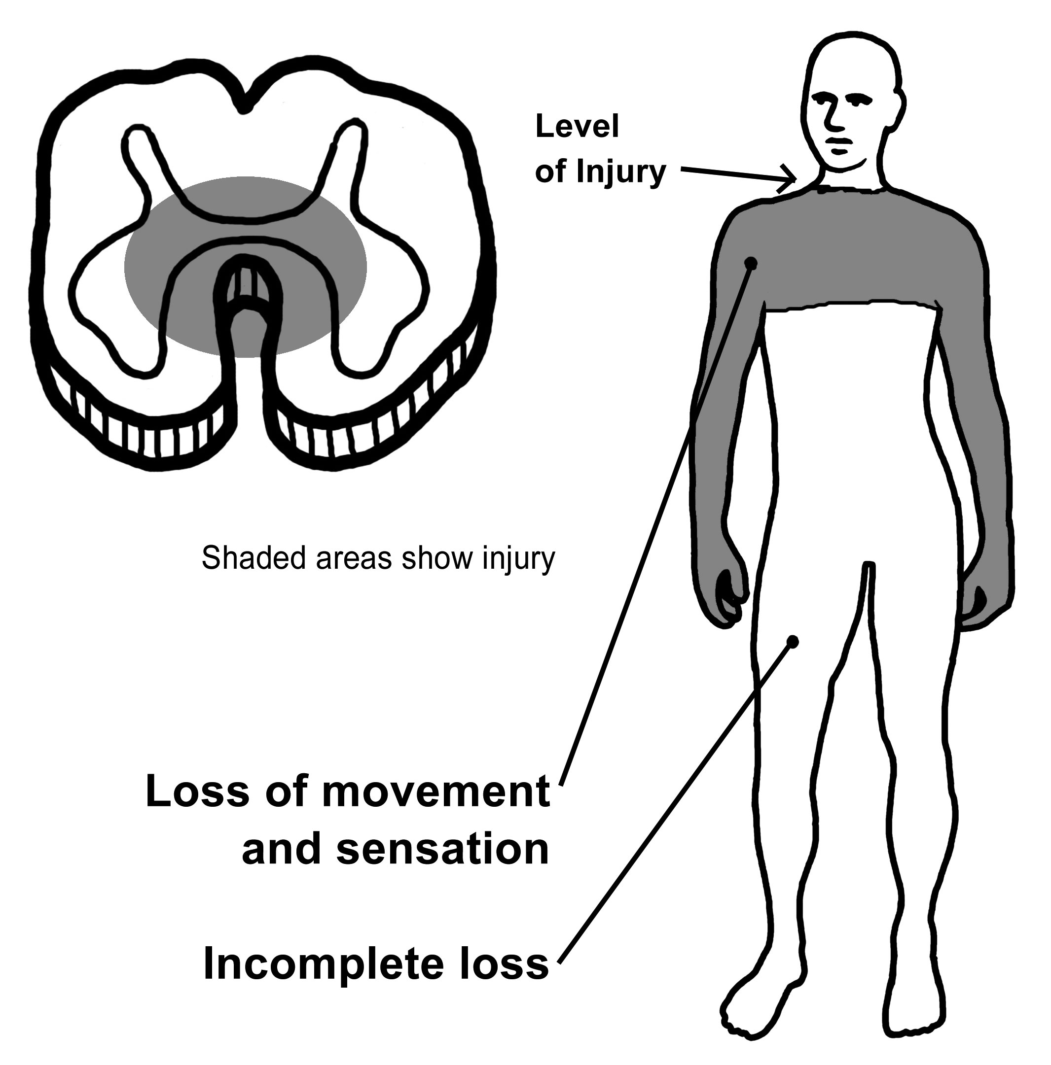 What happens to the spinal cord? | University of Iowa Hospitals & Clinics