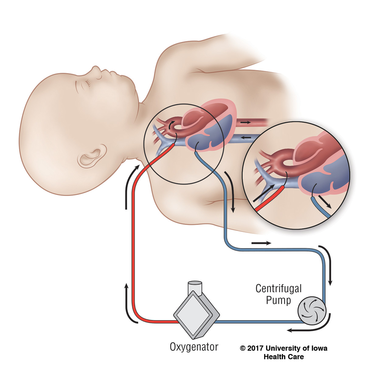 Different types of ECMO University of Iowa Hospitals & Clinics