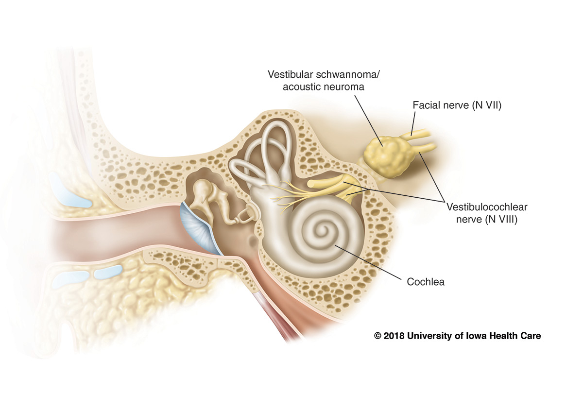 Acoustic neuroma University of Iowa Hospitals & Clinics