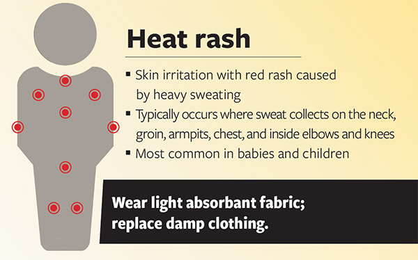 Heat Rash University Of Iowa Hospitals And Clinics