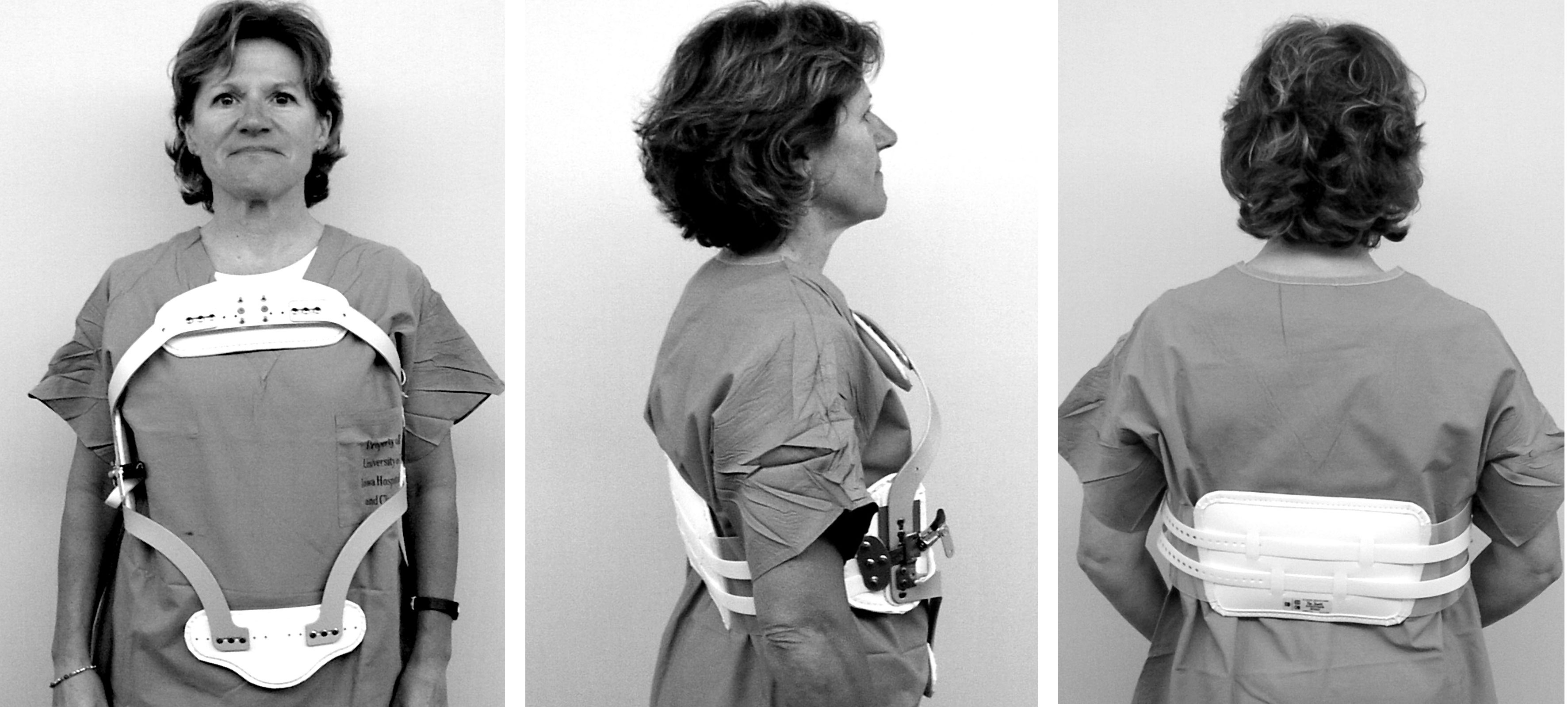 How are spinal cord injuries treated? University of Iowa Hospitals