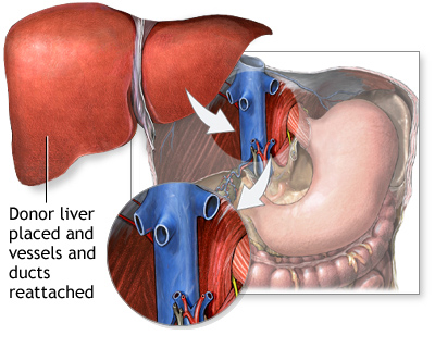 Liver Transplant for Web