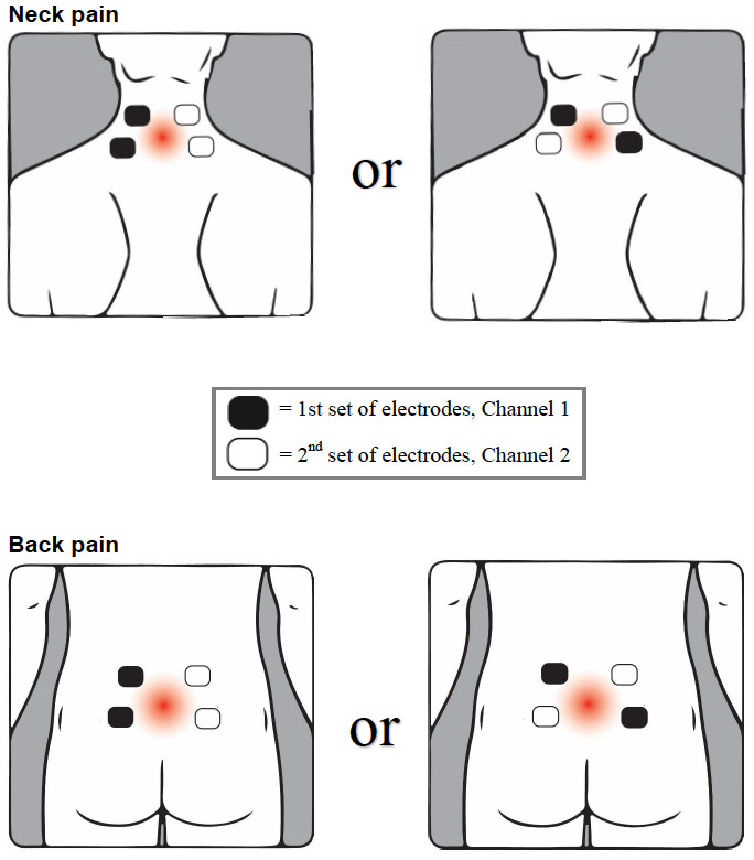 Transcutaneous electrical nerve stimulator (TENS) | University of Iowa ...