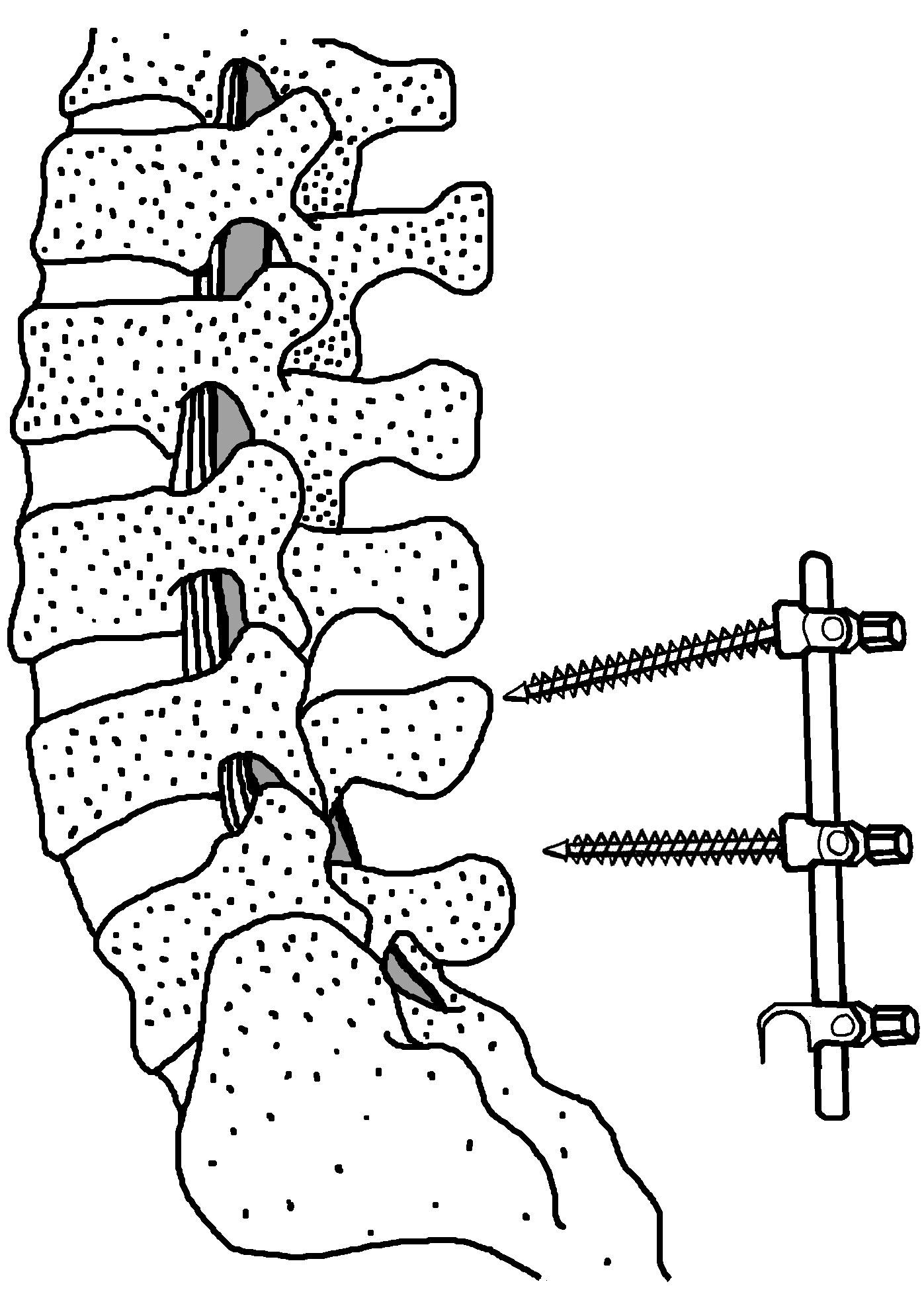How are spinal cord injuries treated? University of Iowa Hospitals